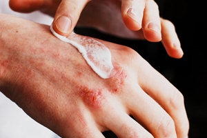درمان اگزمای پوستی به چه شکل است؟